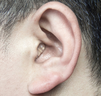 Cadenza T21 Digital 2 channels Small Hearing Aids